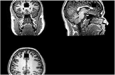 Inflammation, Glutamate, and Cognition in Bipolar Disorder Type II: A Proof of Concept Study